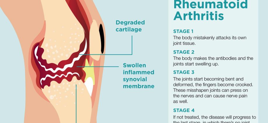 How does rheumatism start?