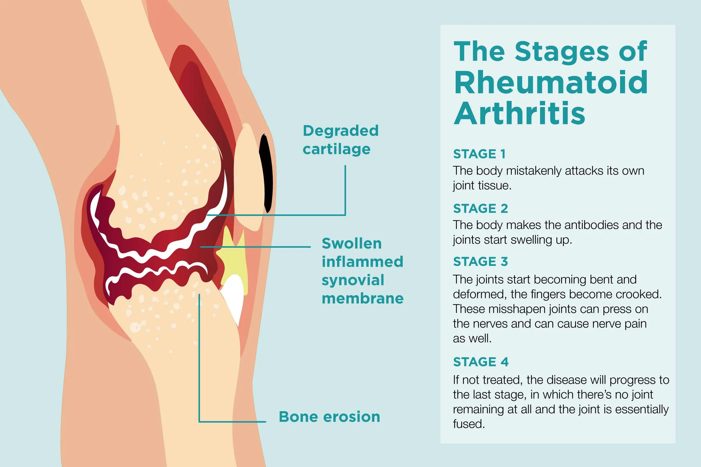 How does rheumatism start?