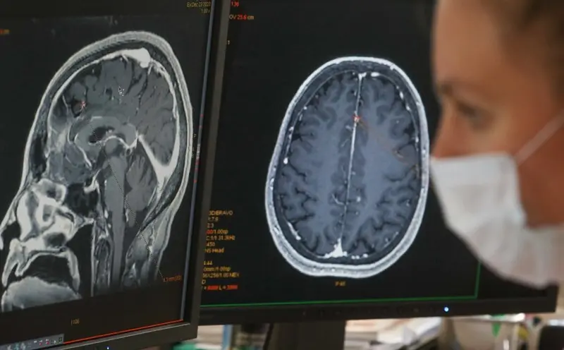 How does the coronavirus attack the brain? The neurosurgeon explains