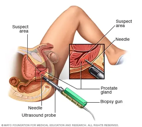 How is a prostate biopsy done?