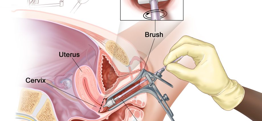 How is cervical cancer treated?