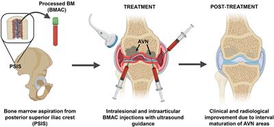 How is it done, i.e. methods of bone marrow harvesting