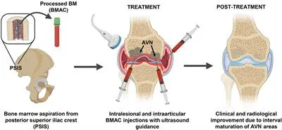 How is it done, i.e. methods of bone marrow harvesting