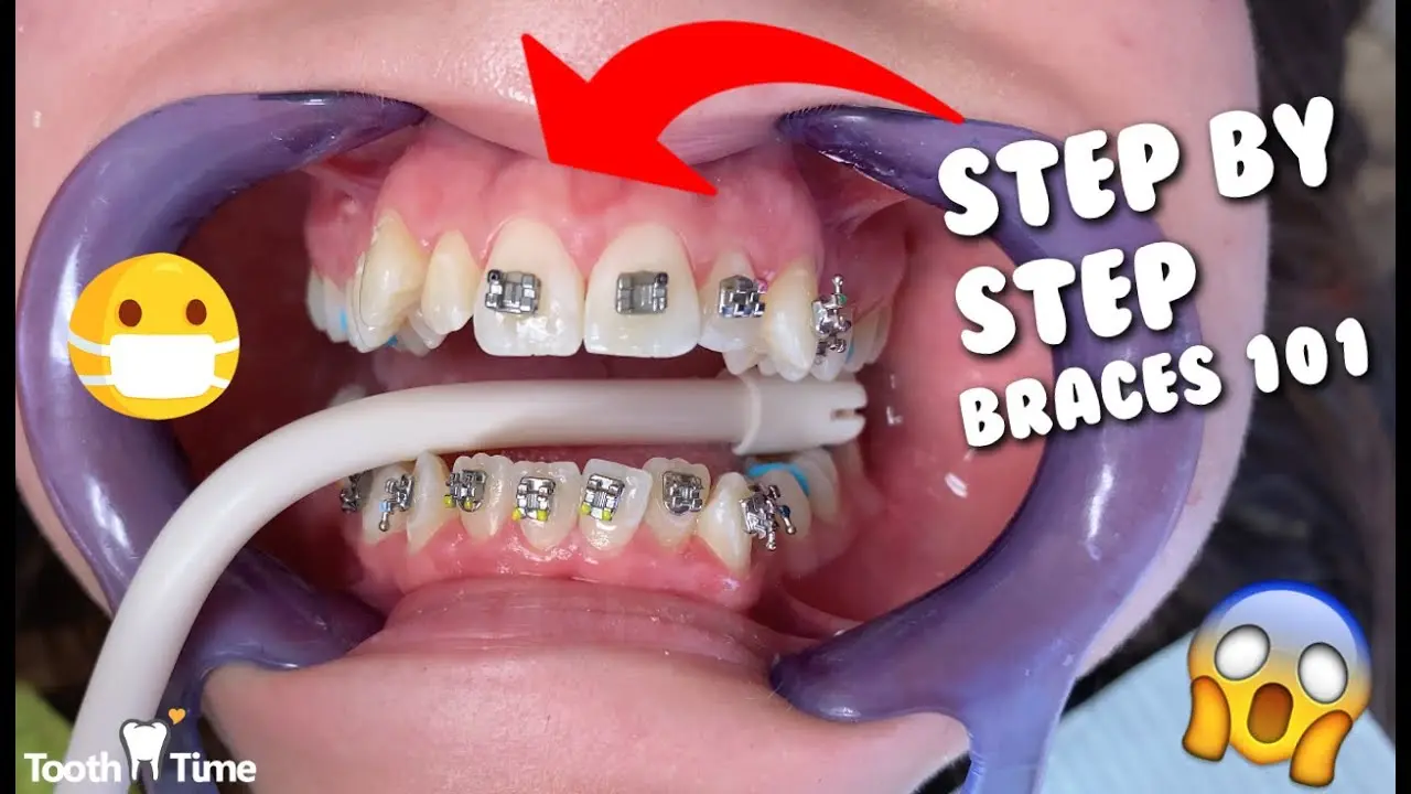 How is orthodontic treatment going? Step by step teeth straightening