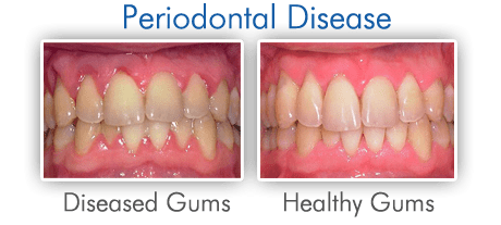 How many percent Poles have healthy gums? These statistics are terrifying