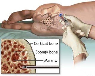 How much do you know about donating bone marrow?