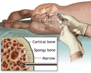 How much do you know about donating bone marrow?