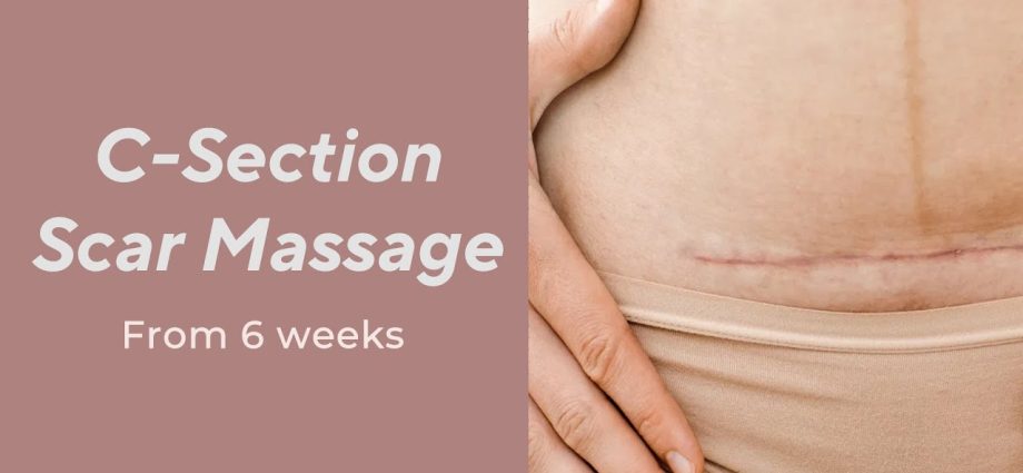 How to care for a caesarean section scar? [video]