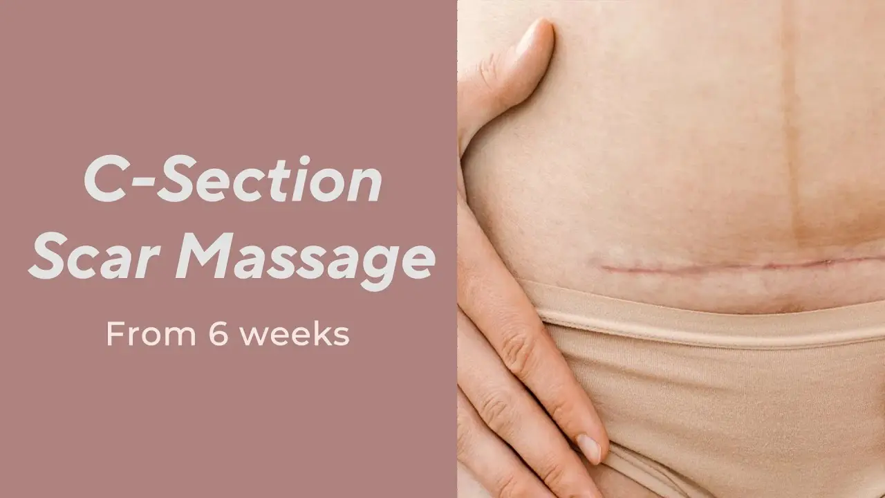 How to care for a caesarean section scar? [video]