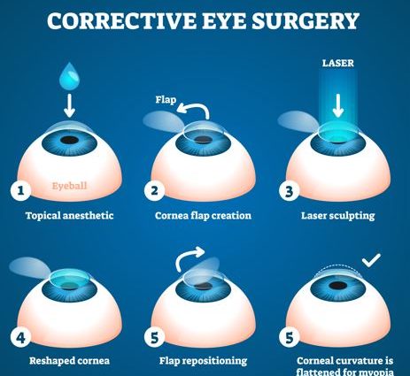 How to choose a method of laser vision correction?