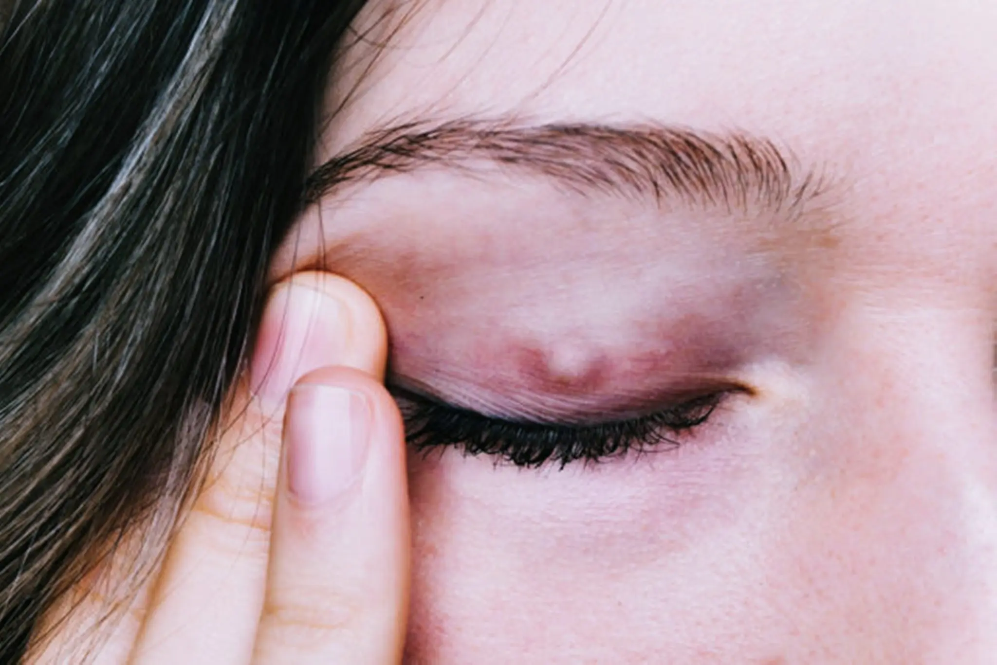 How to deal with festering eyes?