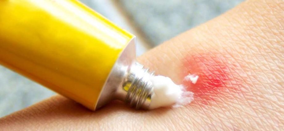 How to deal with mosquito bites? There are home remedies for this. These products can help