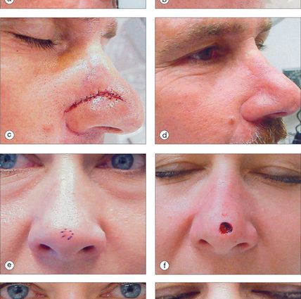 How to deal with wounds in the nose?