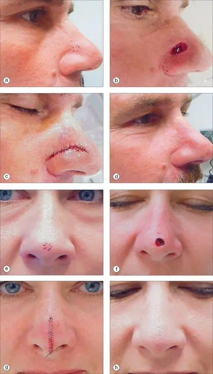 How to deal with wounds in the nose?