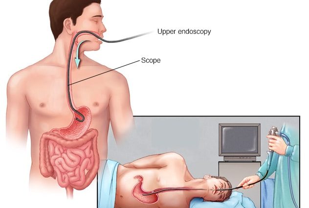 How to detect stomach cancer?