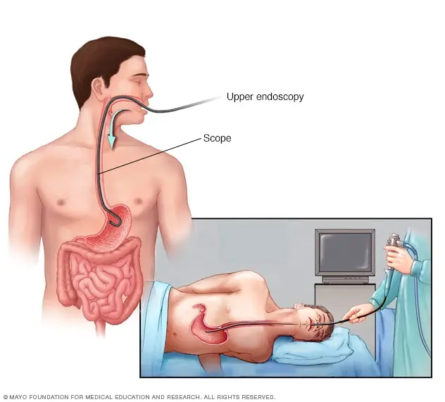 How to detect stomach cancer?