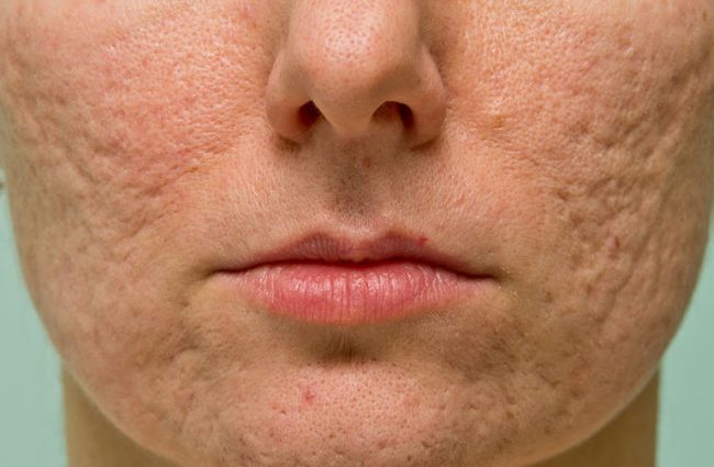 How to get rid of acne?