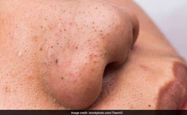 How to get rid of blackheads?