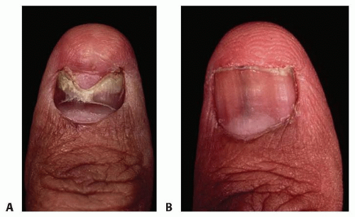 How To Heal A Damaged Nail Matrix Healthy Food Near Me