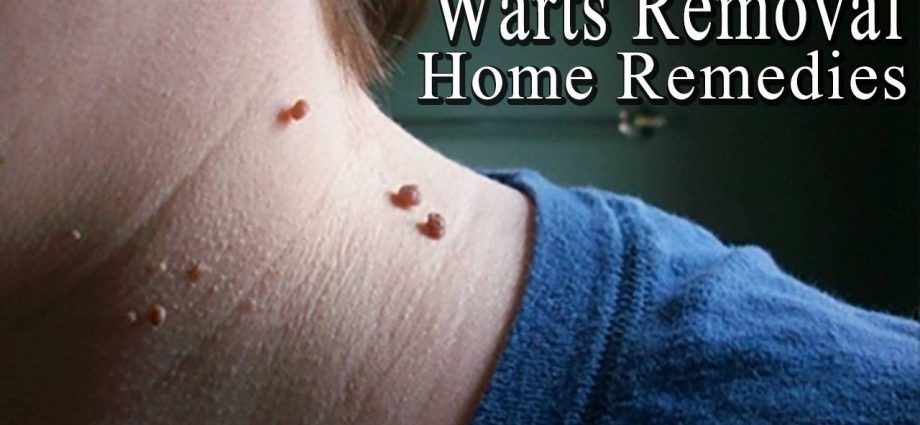 How to permanently remove warts on the neck?