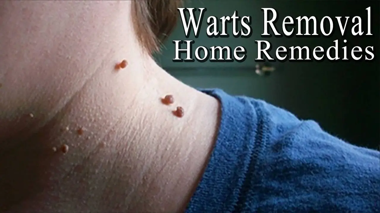 How to permanently remove warts on the neck?