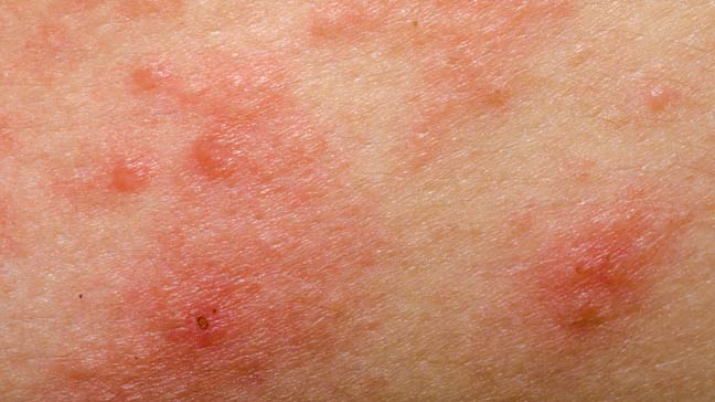 How to recognize an allergic rash? Causes, symptoms and treatment of skin allergies