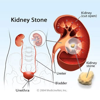 How to recognize kidney stones?