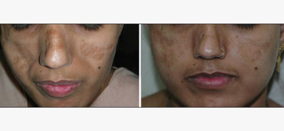 How to remove a scar? Methods, advantages and disadvantages