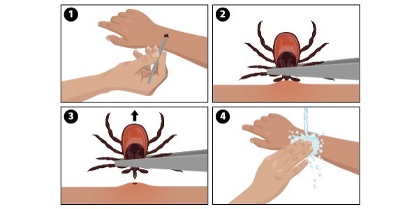 How to remove a tick? Ways to get the tick out of the skin