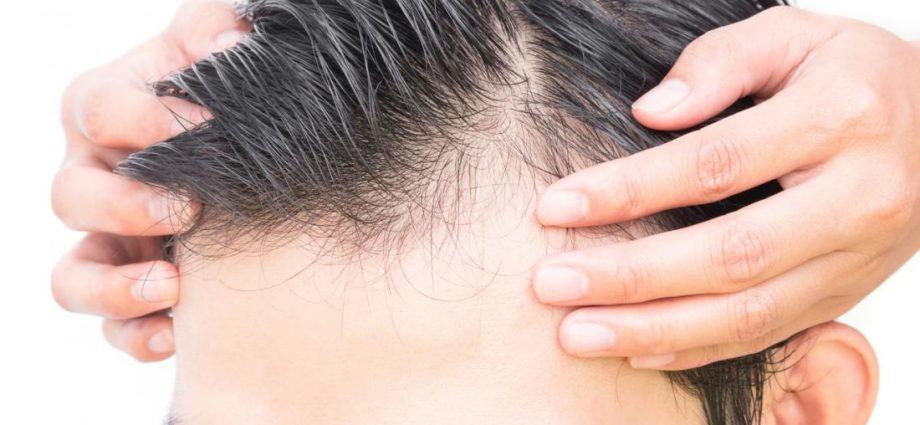 How to stop the hair loss process? The most common causes of baldness