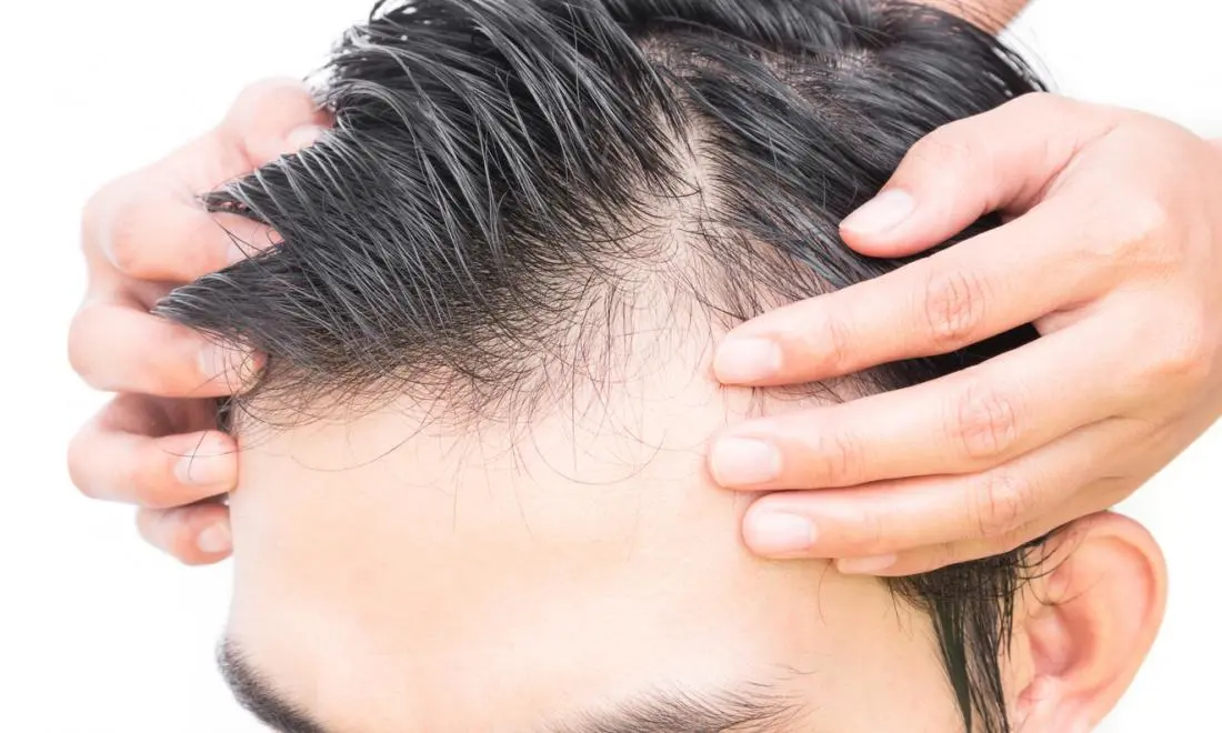 How to stop the hair loss process? The most common causes of baldness