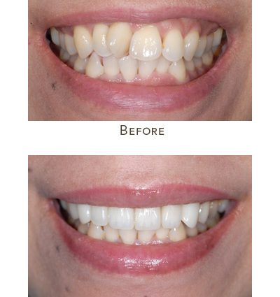 How to straighten crooked teeth?