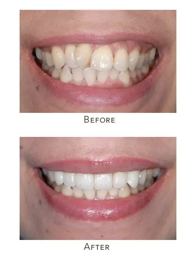 How to straighten crooked teeth?