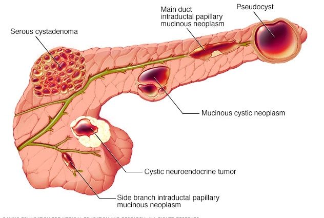 How to treat a cyst on the pancreas?