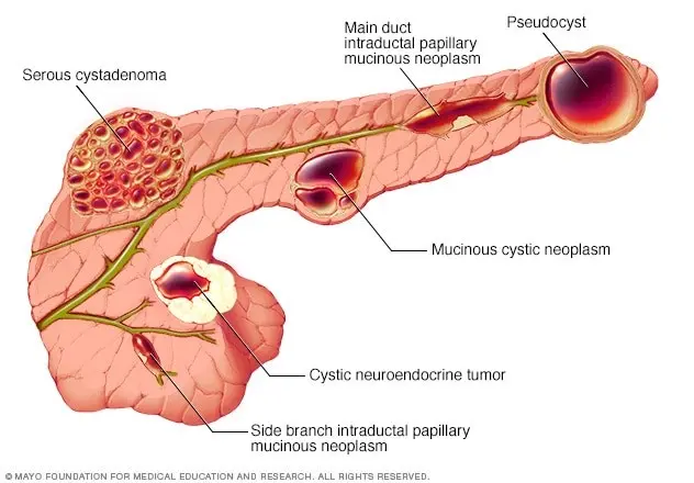 How to treat a cyst on the pancreas?