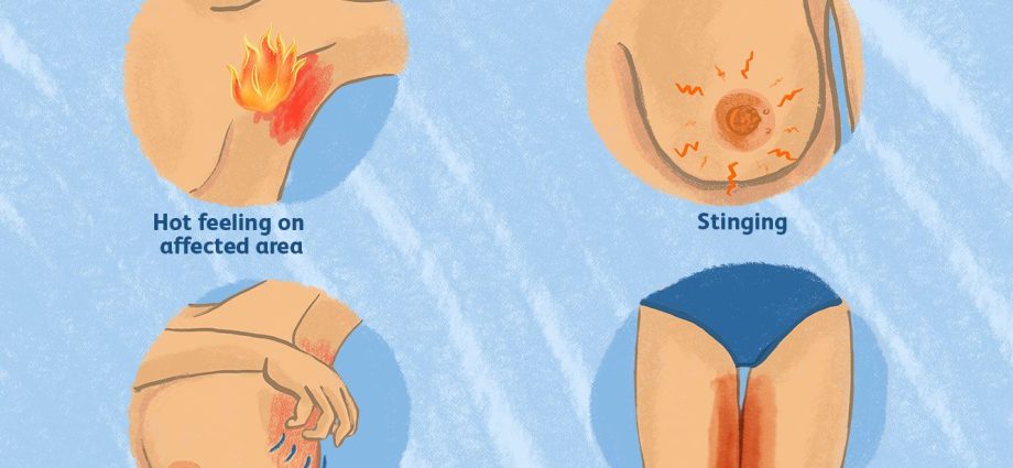 How to treat and prevent chafing on your thighs? WE EXPLAIN