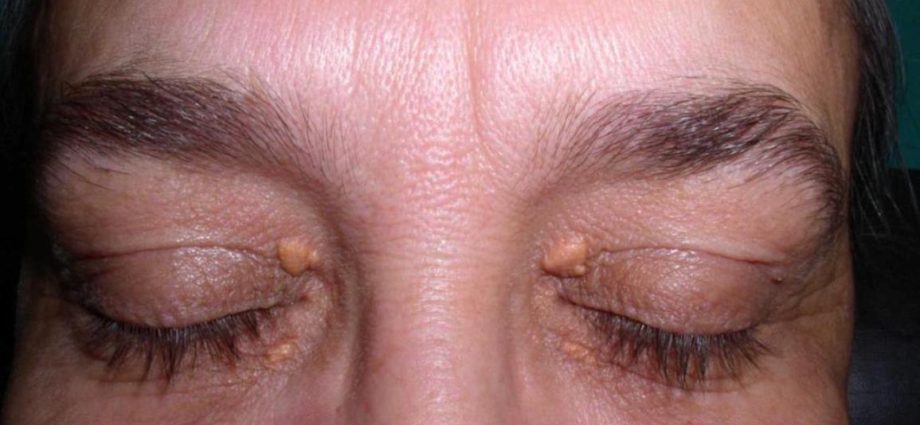 How to treat atheroma on the eyelid?