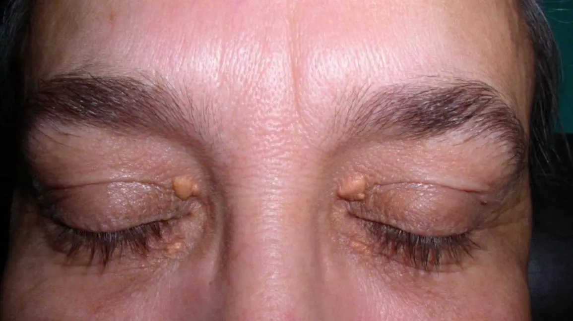 How to treat atheroma on the eyelid?