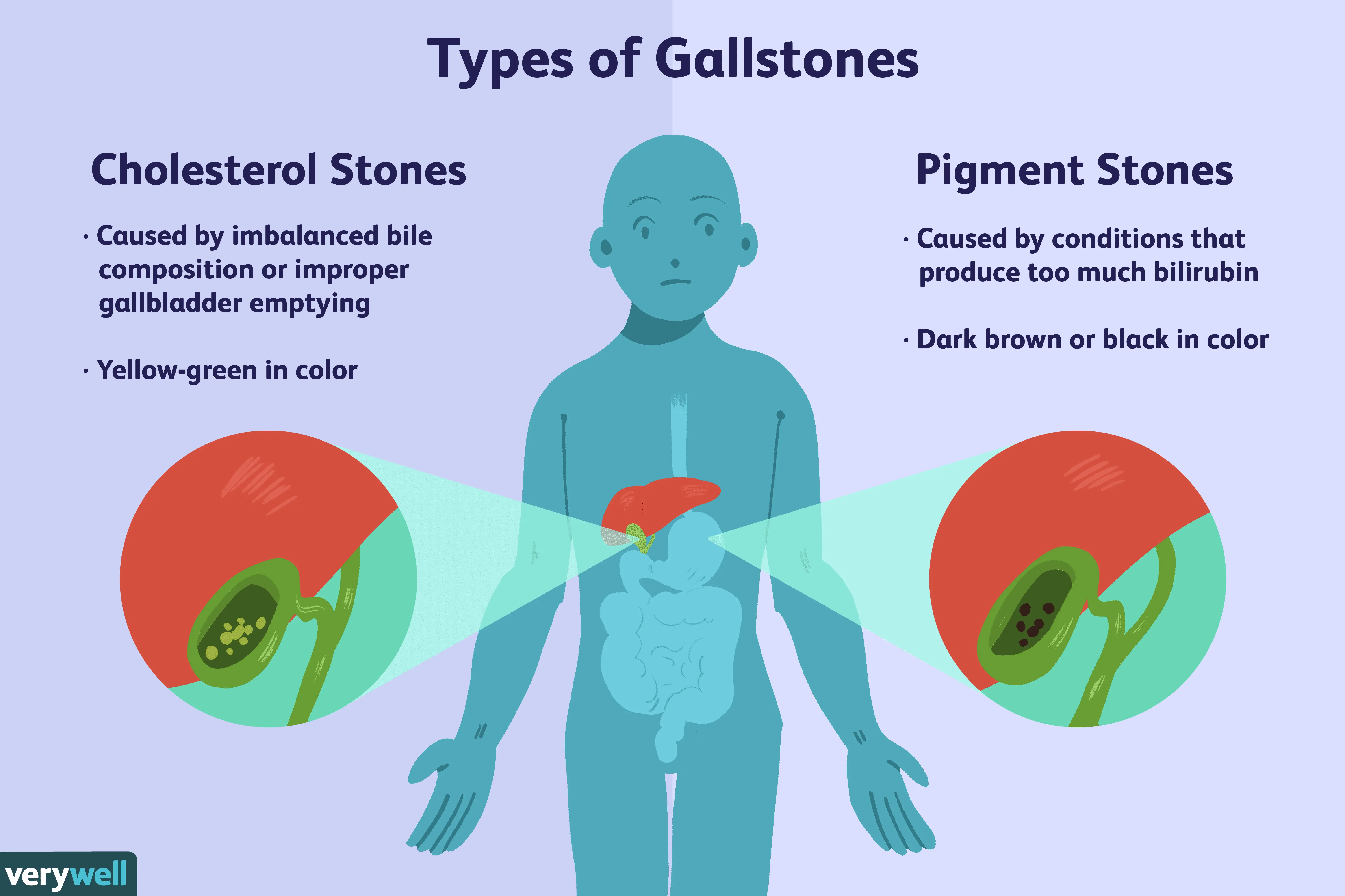 How to treat gallbladder stones?