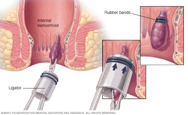 How to Treat Hemorrhoids?