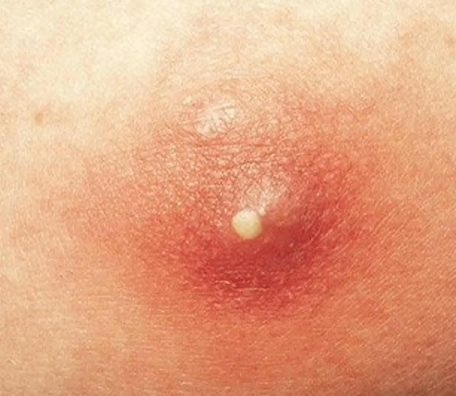 How to treat pimples on the penis?