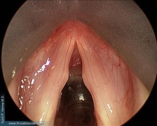 How to treat polyps in the throat?