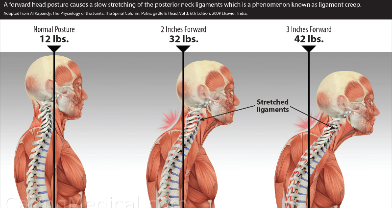 How to treat reduced cervical lordosis?