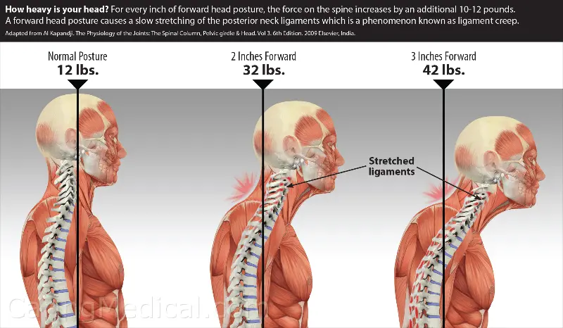 How to treat reduced cervical lordosis?