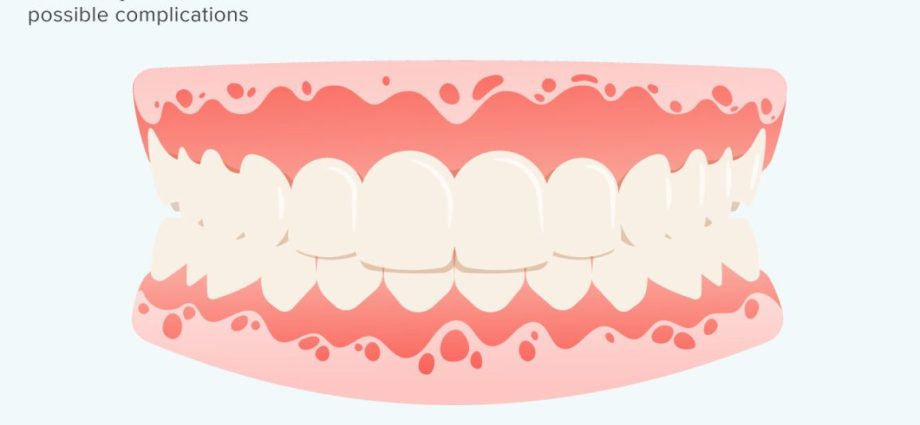 How to treat staphylococcus in the throat?