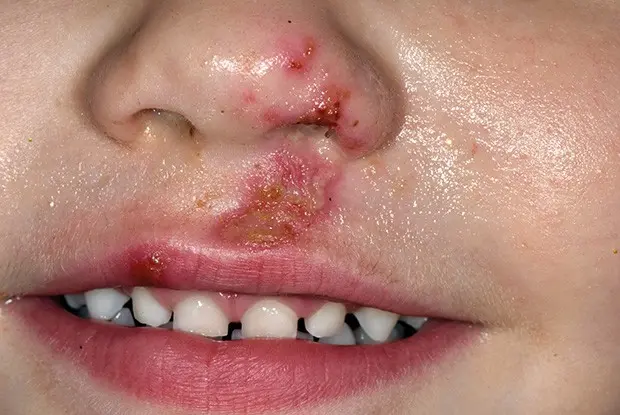 How to treat ulcers on the face?