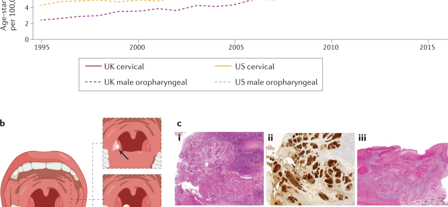 HPV associato a un terzo dei casi di cancro alla gola