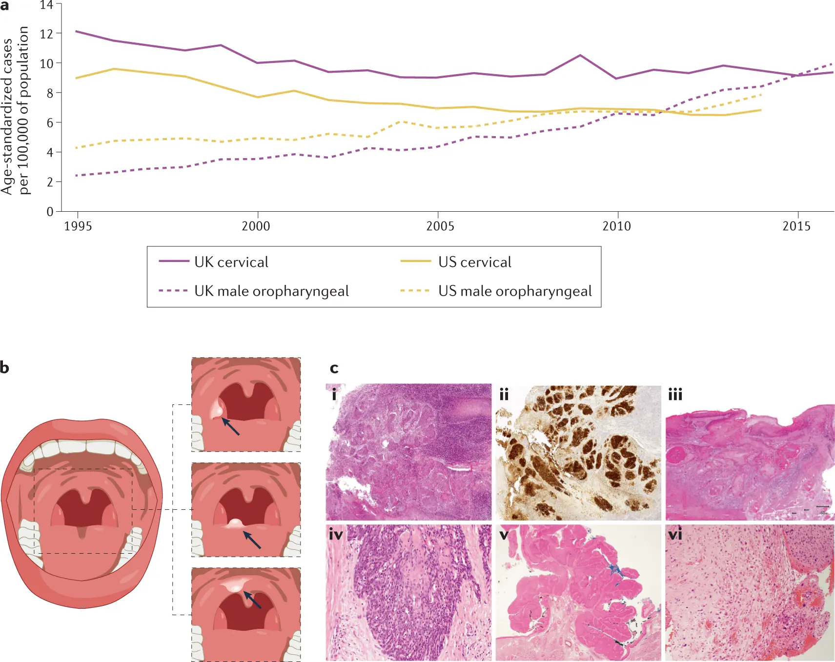 HPV associated with one-third of throat cancer cases