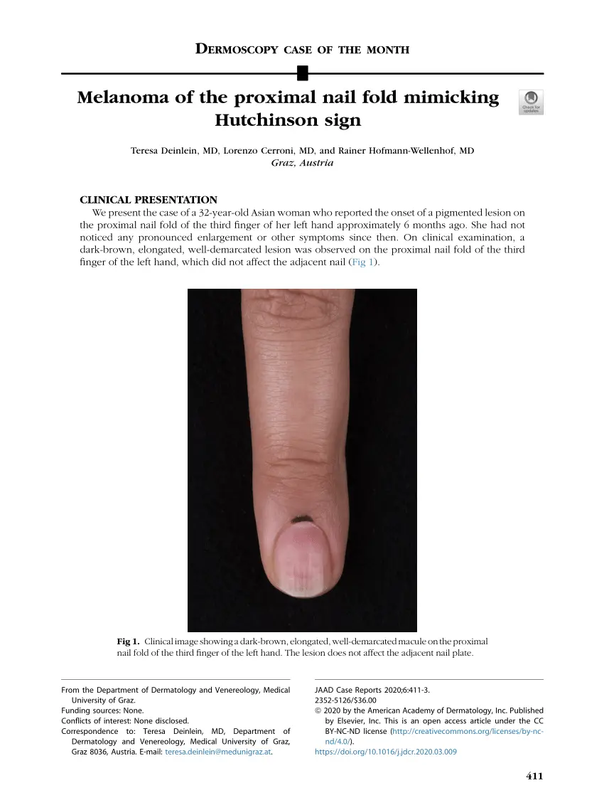 Hutchinson&#8217;s symptom (distal melanoma) &#8211; when does it occur?