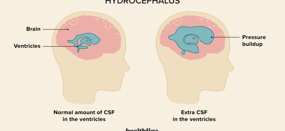 Hydrocephalus in children and adults. Causes, symptoms, treatment